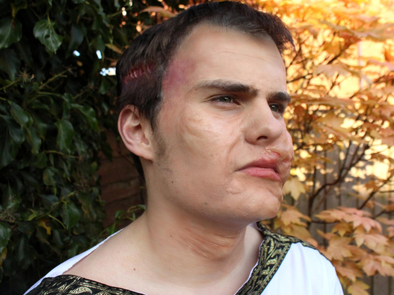 A man dressed as a Roman with prosthetic makeup used to reconstruct an injury